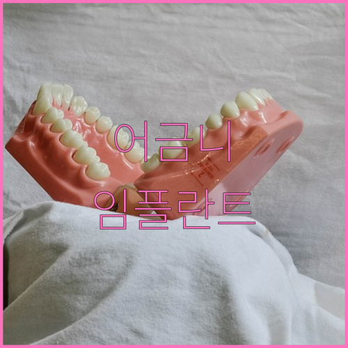 어금니 임플란트 가격, 이것만 알면 합리적인 선택 가능
